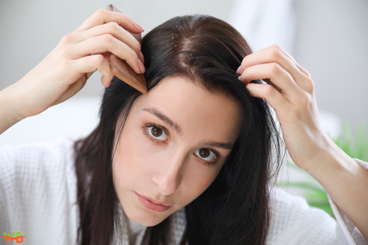 can dandruff cause hair loss?