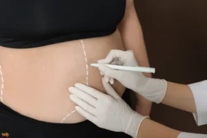 Tummy Tuck