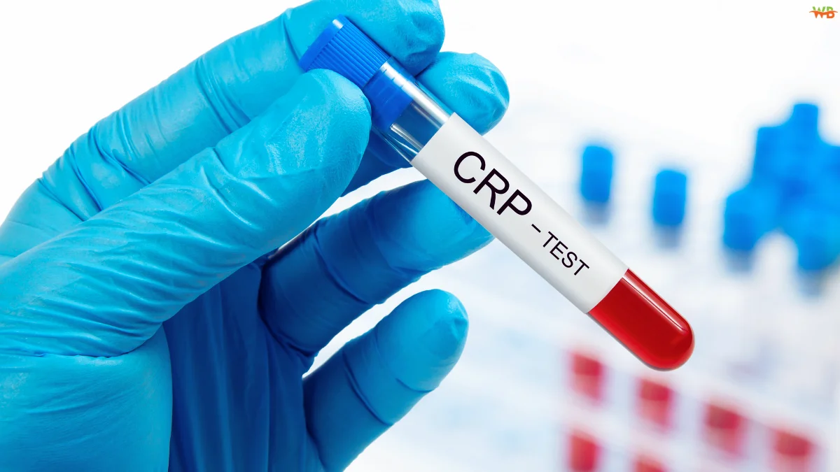 CRP Blood Test