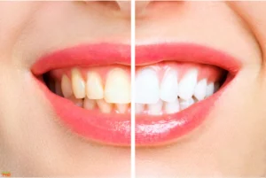 Steps to Getting Invisalign Treatment in Branson, MO Invisalign