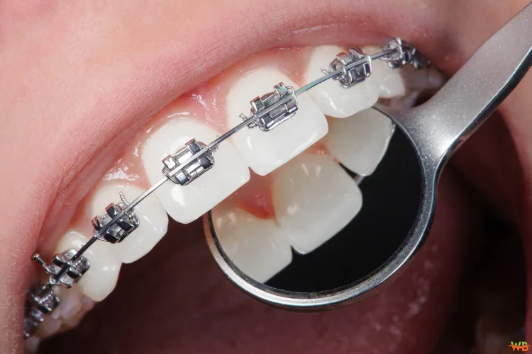 Lingual Braces