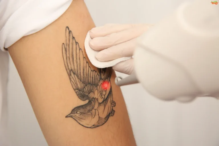 Laser Tattoo Removal