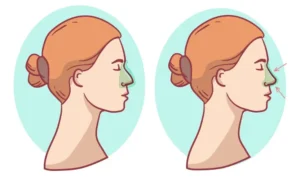 Exploring the Surprising Benefits of Rhinoplasty Beyond Aesthetics Rhinoplasty