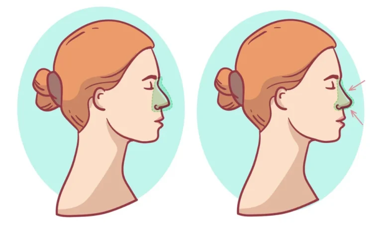 Rhinoplasty