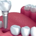 What Are Dental Implants?