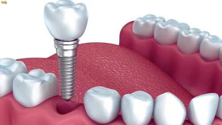 What Are Dental Implants?