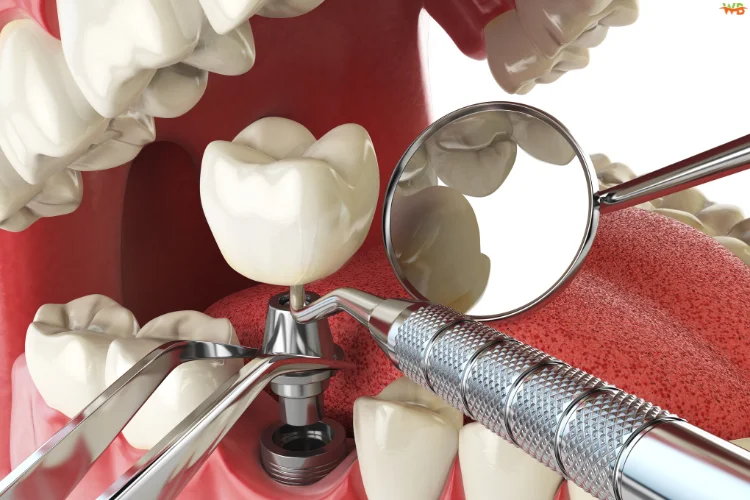 The Dental Implant Procedure: What to Expect