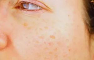 The Ultimate Guide to Liver Spots Removers: Treatments, Prevention, and Tips for Clear Skin Liver Spots