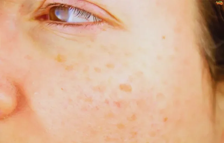 Liver Spots