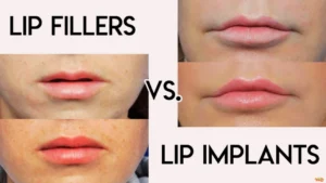 Difference Between Lip Fillers and Lip Implants Lip Implants