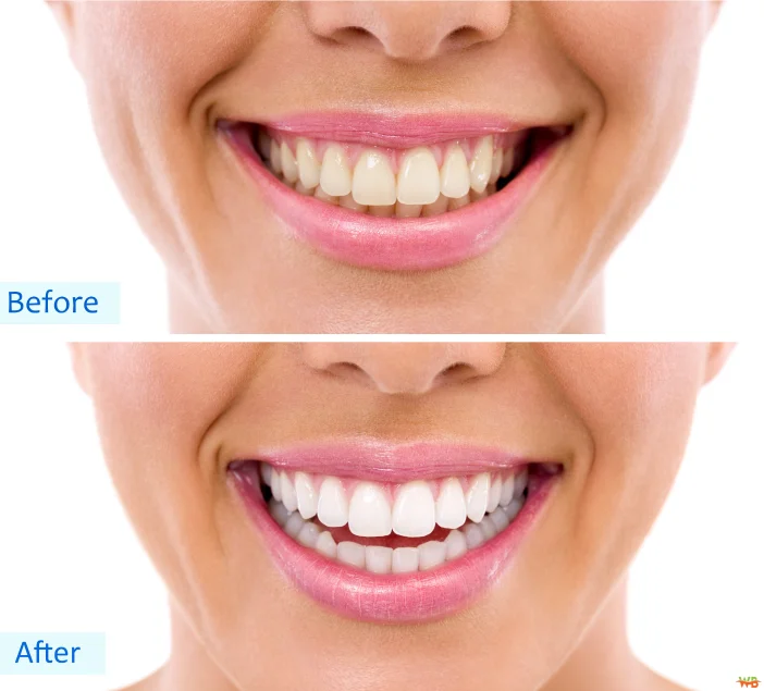 Consider Cosmetic Dentistry for a Confidence Boost