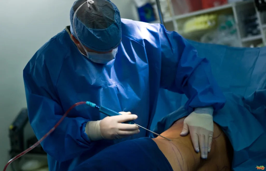 Liposuction