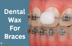 Dental Wax for Braces: Simple Relief from Pain dental wax for braces