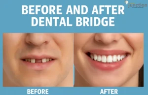 Before and After Dental Bridge